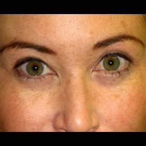 Before-Periorbital Filler