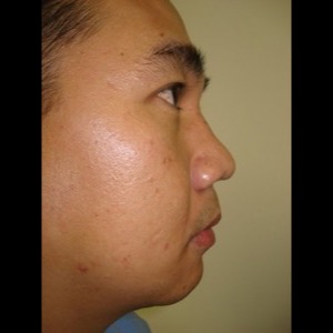 Before-Nose and Chin