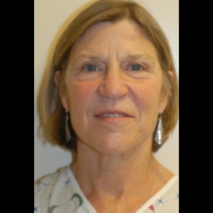 Before-Liquid Facelift