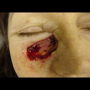 Before-Cheek Reconstruction