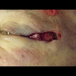 Before-Eyelid Reconstruction