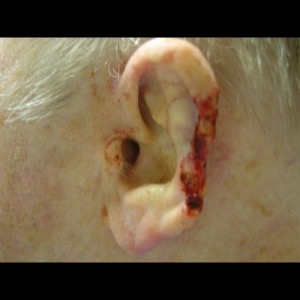 Before-Ear Reconstruction