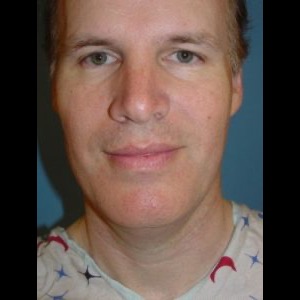 Before-Neck Liposuction