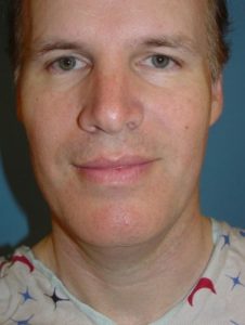 Before-Neck Liposuction