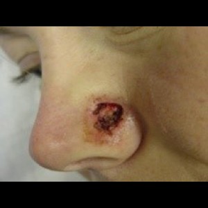 Before-Nose Reconstruction