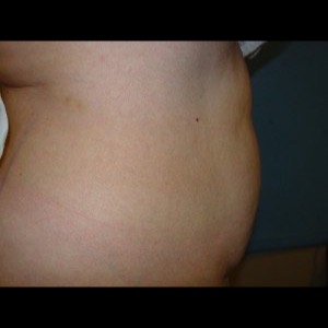 Before-Liposuction