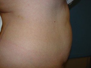 After-Liposuction