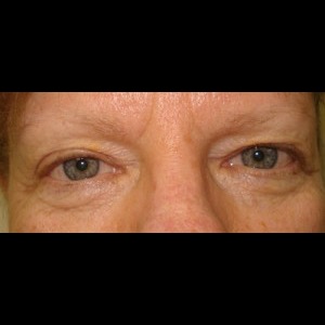 Before-Upper & Lower Blepharoplasty