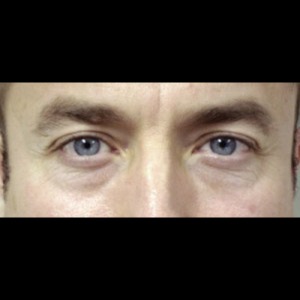 Before-Lower Blepharoplasty