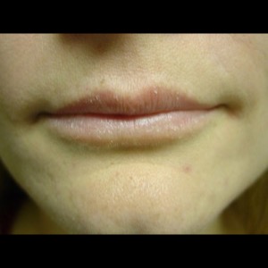 Before-Lip Augmentation