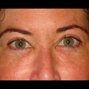 After-Periorbital Filler