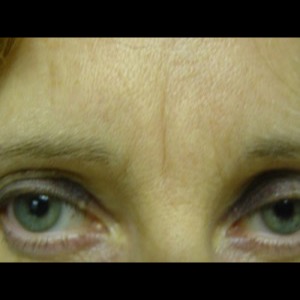 After-Glabella