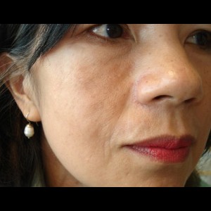 After-Hemifacial Atrophy