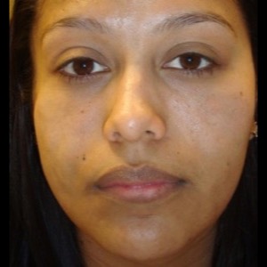 After-Filler For Lupus