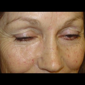 After-Cheek Reconstruction