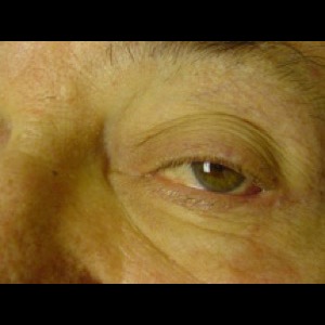 After-Eyelid Reconstruction