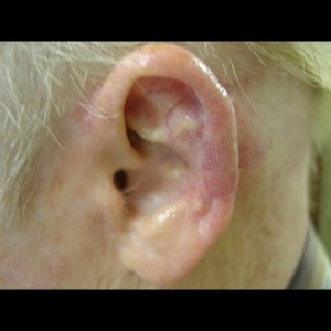 After-Ear Reconstruction