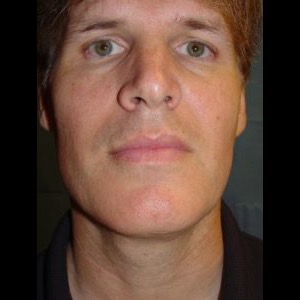 After-Neck Liposuction