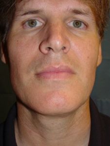 After-Neck Liposuction