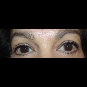 Before-Upper Blepharoplasty