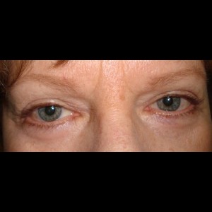 After-Upper & Lower Blepharoplasty