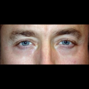 After-Lower Blepharoplasty