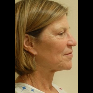 Before-Liquid Facelift