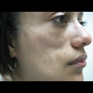 Before-Filler For Lupus