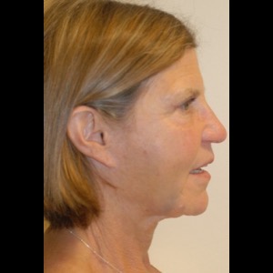 After-Liquid Facelift