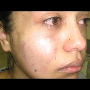 After-Filler For Lupus