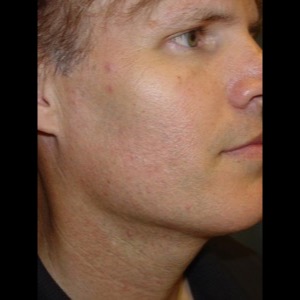After-Neck Liposuction
