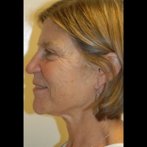 Before-Liquid Facelift