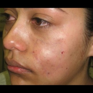 After-Filler For Lupus