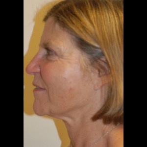 After-Liquid Facelift