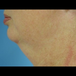 Before-Neck Liposuction