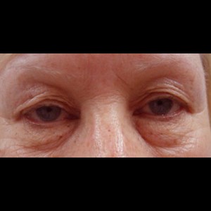 Before-Upper & Lower Blepharoplasty