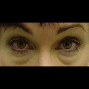 Before-Lower Blepharoplasty