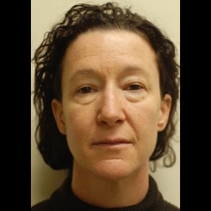 Before-Liquid Facelift