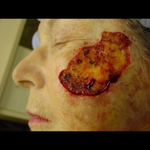 Before-Cheek Reconstruction