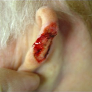 Before-Ear Reconstruction