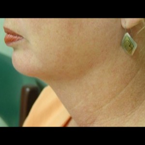 After-Neck Liposuction