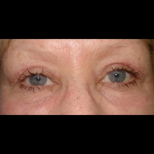 After-Upper & Lower Blepharoplasty