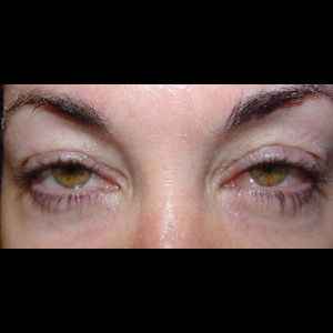 After-Lower Blepharoplasty
