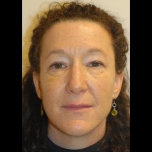 After-Liquid Facelift