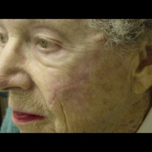 After-Cheek Reconstruction