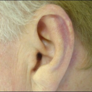After-Ear Reconstruction