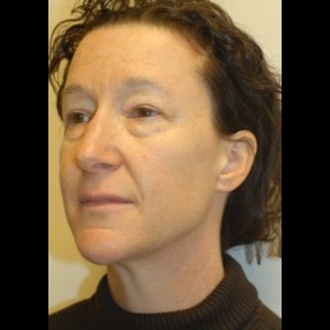 Before-Liquid Facelift