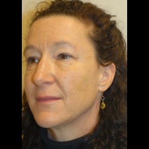 After-Liquid Facelift