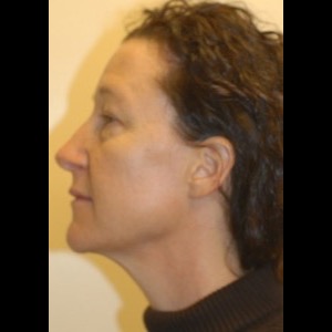 Before-Liquid Facelift