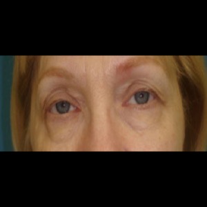 Before-Upper & Lower Blepharoplasty